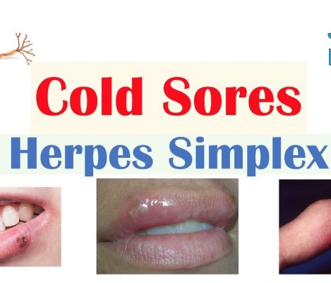 oral herpes Archives - Best Heath Solution For You