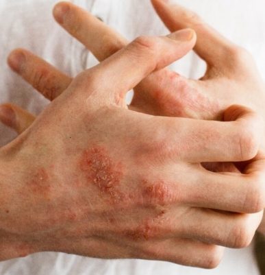 Tips About Eczema That Can Improve Your Life