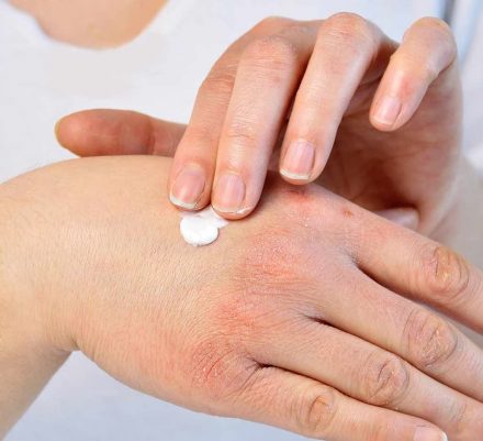 This Article Is The Perfect Read For Any Eczema Sufferer