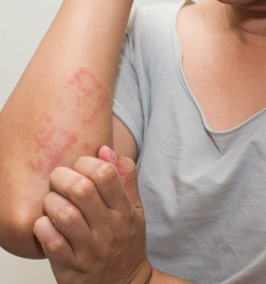 Understanding The Treatment Of Eczema - Tips That Can Help You Find Relief!