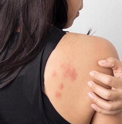 Use These Tips To Make Eczema A Past Memory