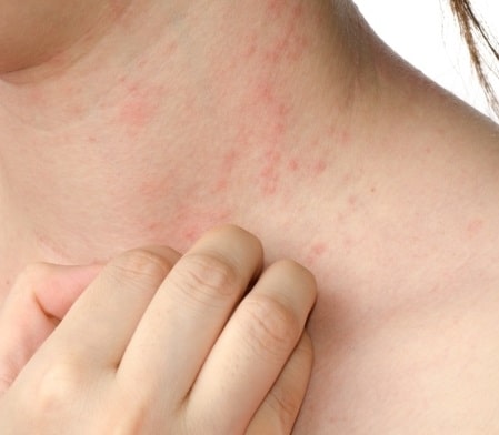 Useful Guidance For Successfully Winning The War Against Eczema