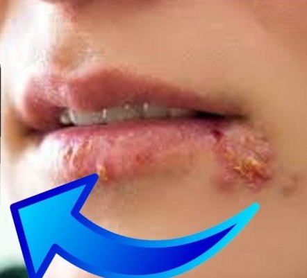 Herpesyl Review - Herpesyl Really Works?