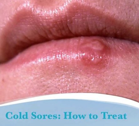 How To Treat Cold Sores