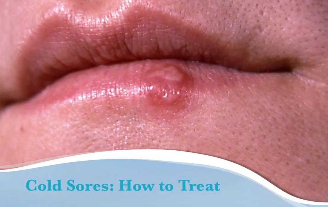 How To Treat Cold Sores