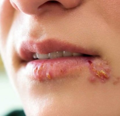 Way to get rid of herpes