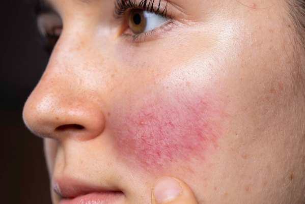 Best Way To Get Rid Of Rosacea