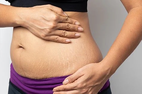 How To Get Rid Of Stretch Marks Naturally
