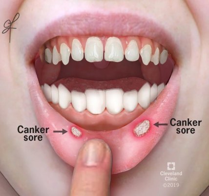 Way To Get Rid Cold Sores Naturally