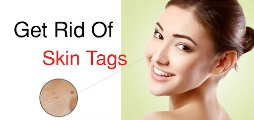 remove skin tags